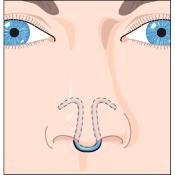 Dilatateur nasal Clip Air